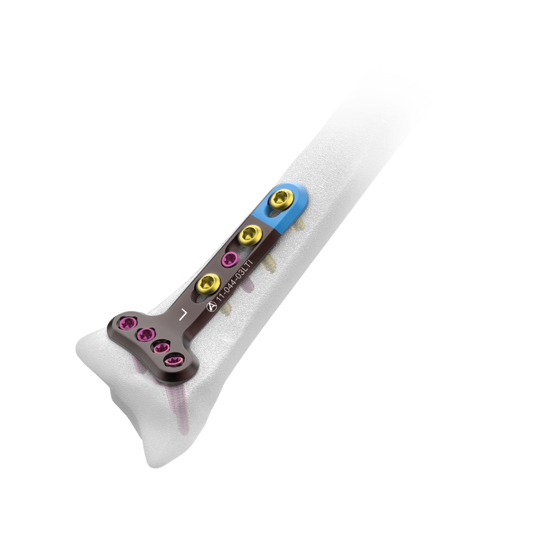 2.4mm-AV-Wiselock-Distal-Radius-Volar-Plate-Extra-articular 2.4mm-AV-Wiselock-Distal-Radius-Volar-Plate-Extra-articular