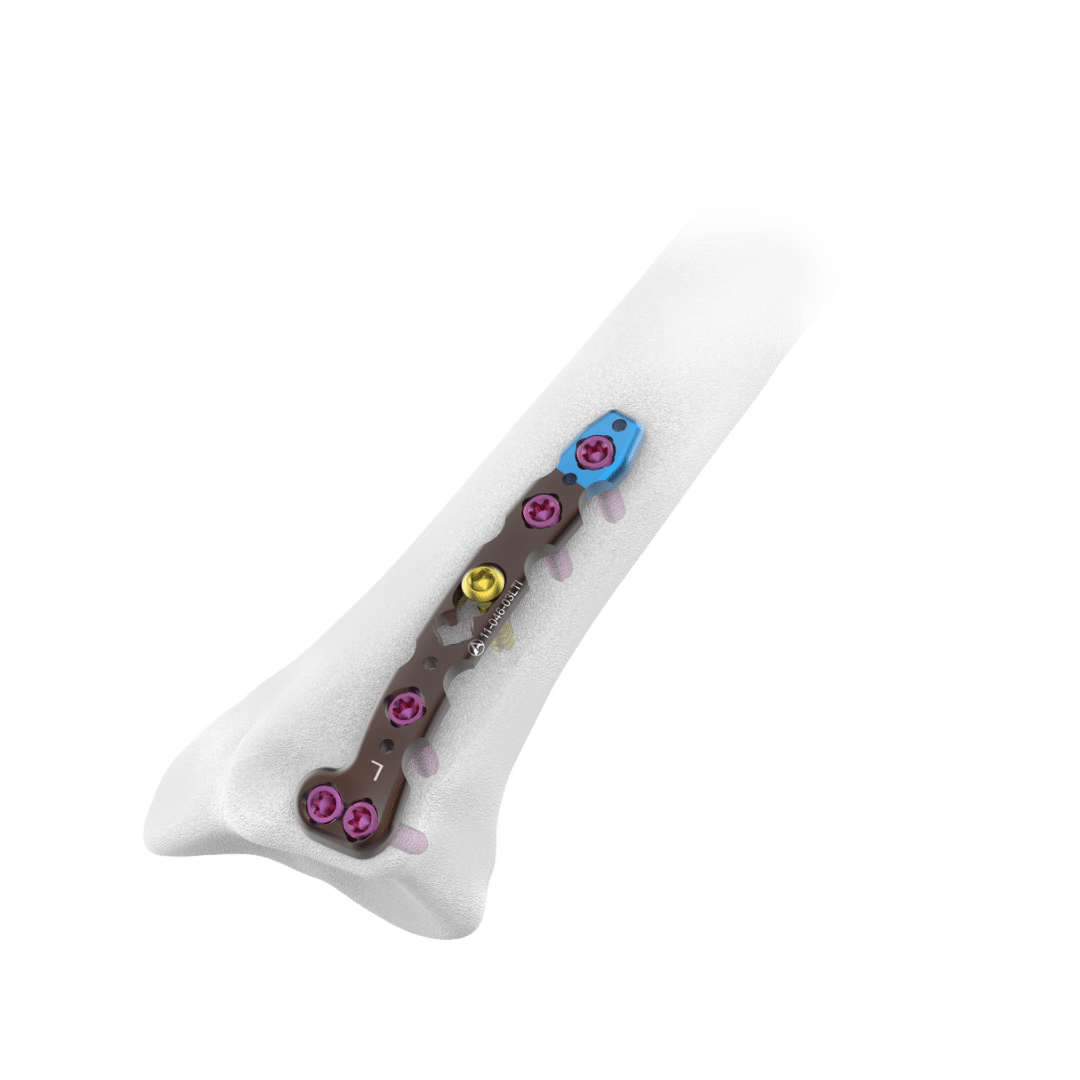 2.4mm-AV-Wiselock-Dorsal-Distal-Radius-Plate-Intermediate-Column 2.4mm-AV-Wiselock-Dorsal-Distal-Radius-Plate-Intermediate-Column