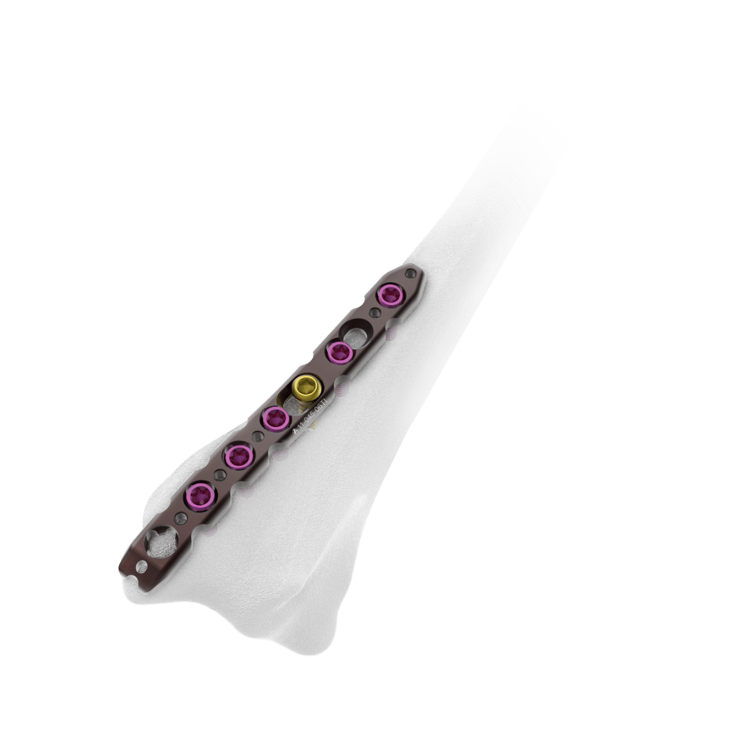 2.4mm-AV-Wiselock-Dorsal-Distal-Radius-Plate-Radial-Column 2.4mm-AV-Wiselock-Dorsal-Distal-Radius-Plate-Radial-Column