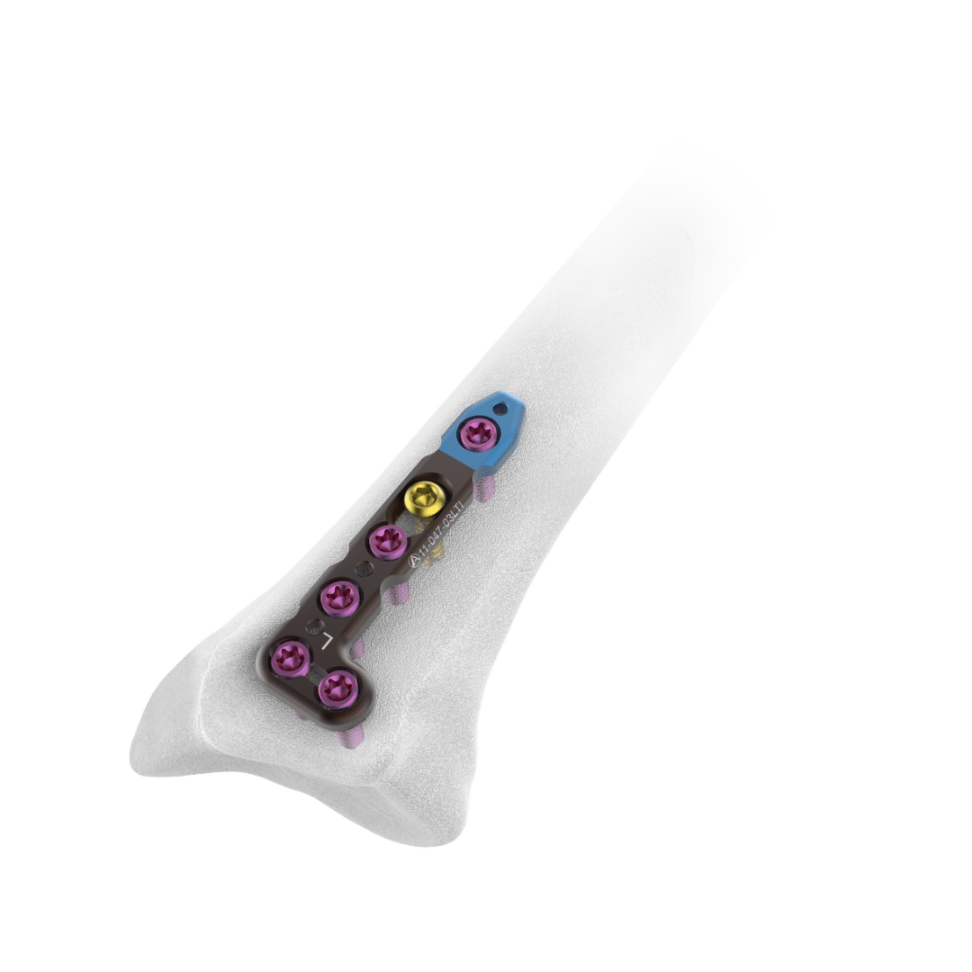 2.4mm-AV-Wiselock-L-Dorsal-Distal-Radius-Plate-2-Head-Holes 2.4mm-AV-Wiselock-L-Dorsal-Distal-Radius-Plate-2-Head-Holes