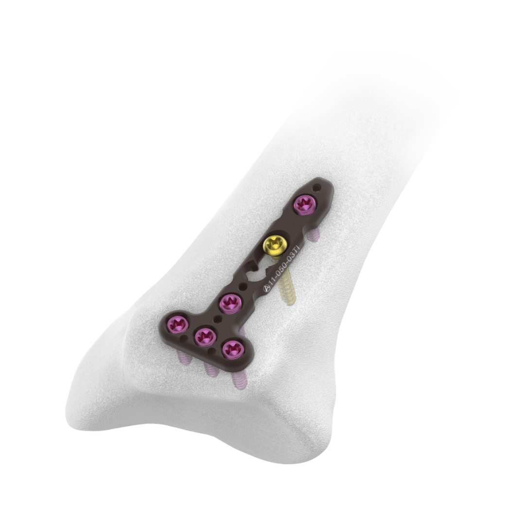 2.4mm-AV-Wiselock-T-Dorsal-Distal-Radius-Plate-3-Head-Holes 2.4mm-AV-Wiselock-T-Dorsal-Distal-Radius-Plate-3-Head-Holes