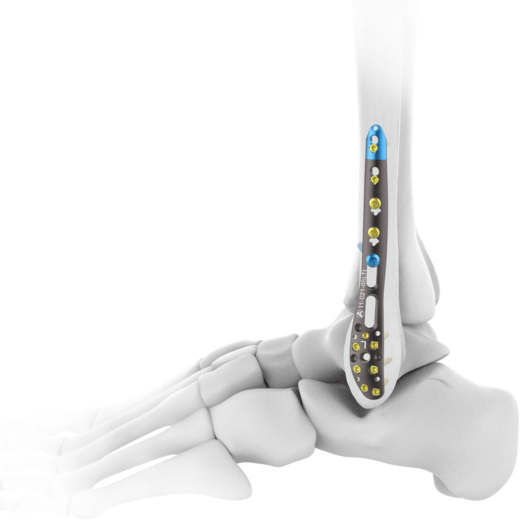2.7-3.5mm-AV-WISELOCK-ANKLE-SYSTEM 2.7-3.5mm-AV-WISELOCK-ANKLE-SYSTEM
