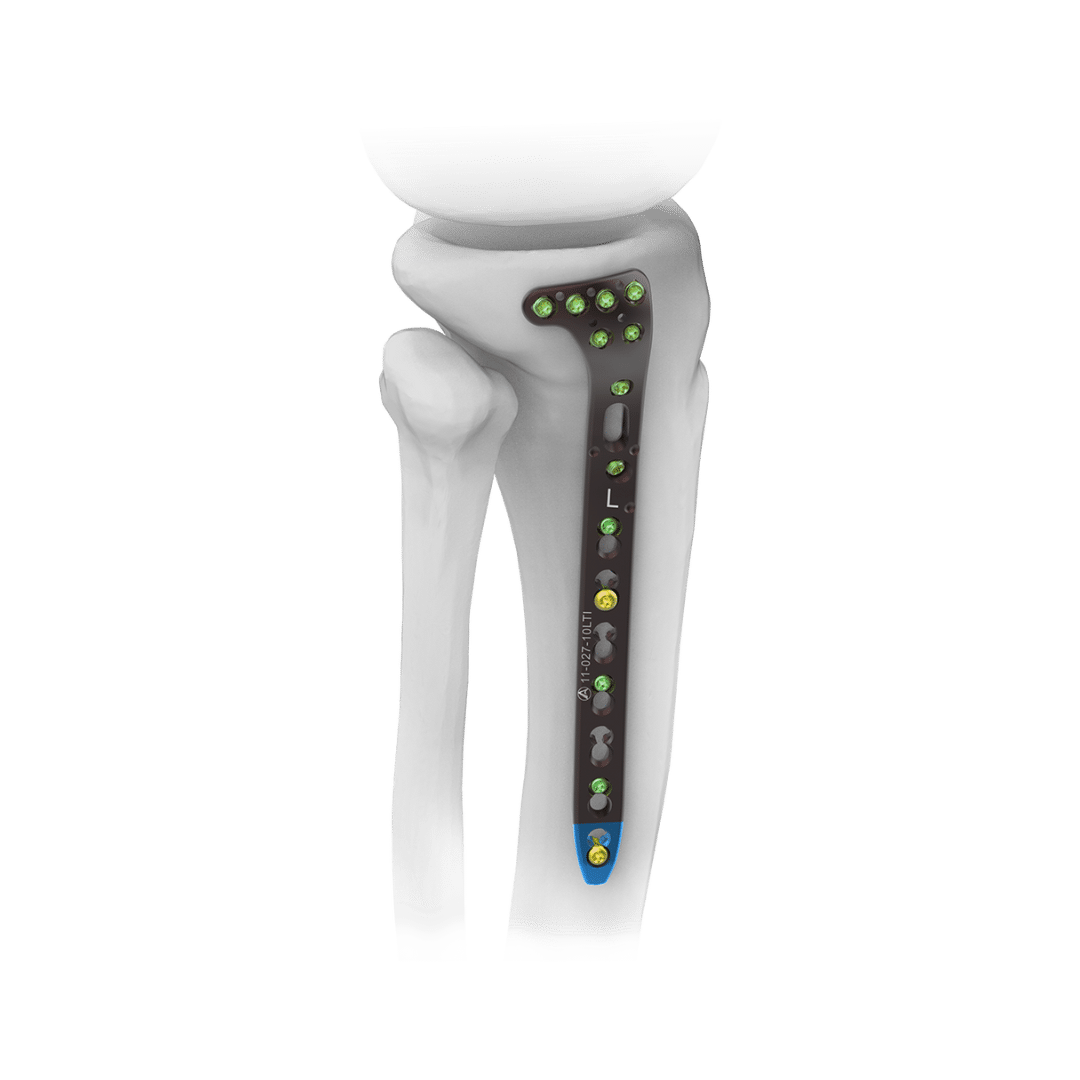 3.5mm-AV-Wiselock-Proximal-Tibia-System 3.5mm-AV-Wiselock-Proximal-Tibia-System